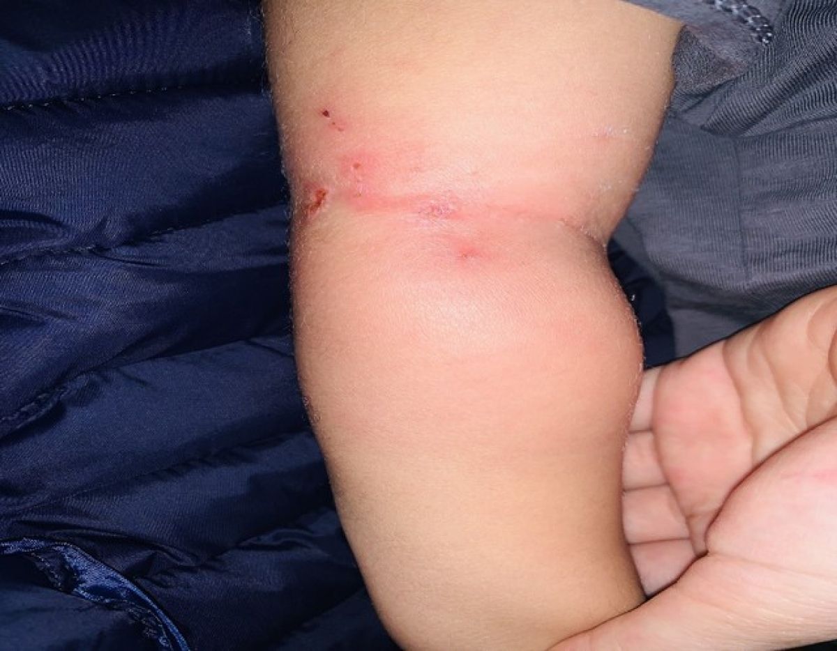 A 25-month-old baby gets sepsis through a mosquito bite