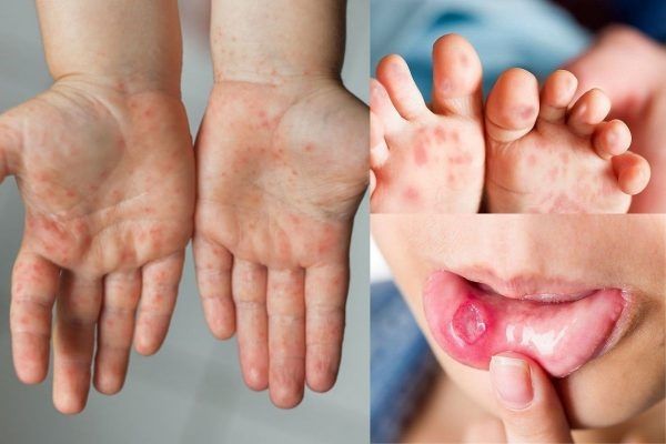 Dak Lak: Strengthening the prevention and control of hand, foot and mouth disease