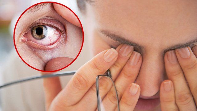 Dry eye syndrome